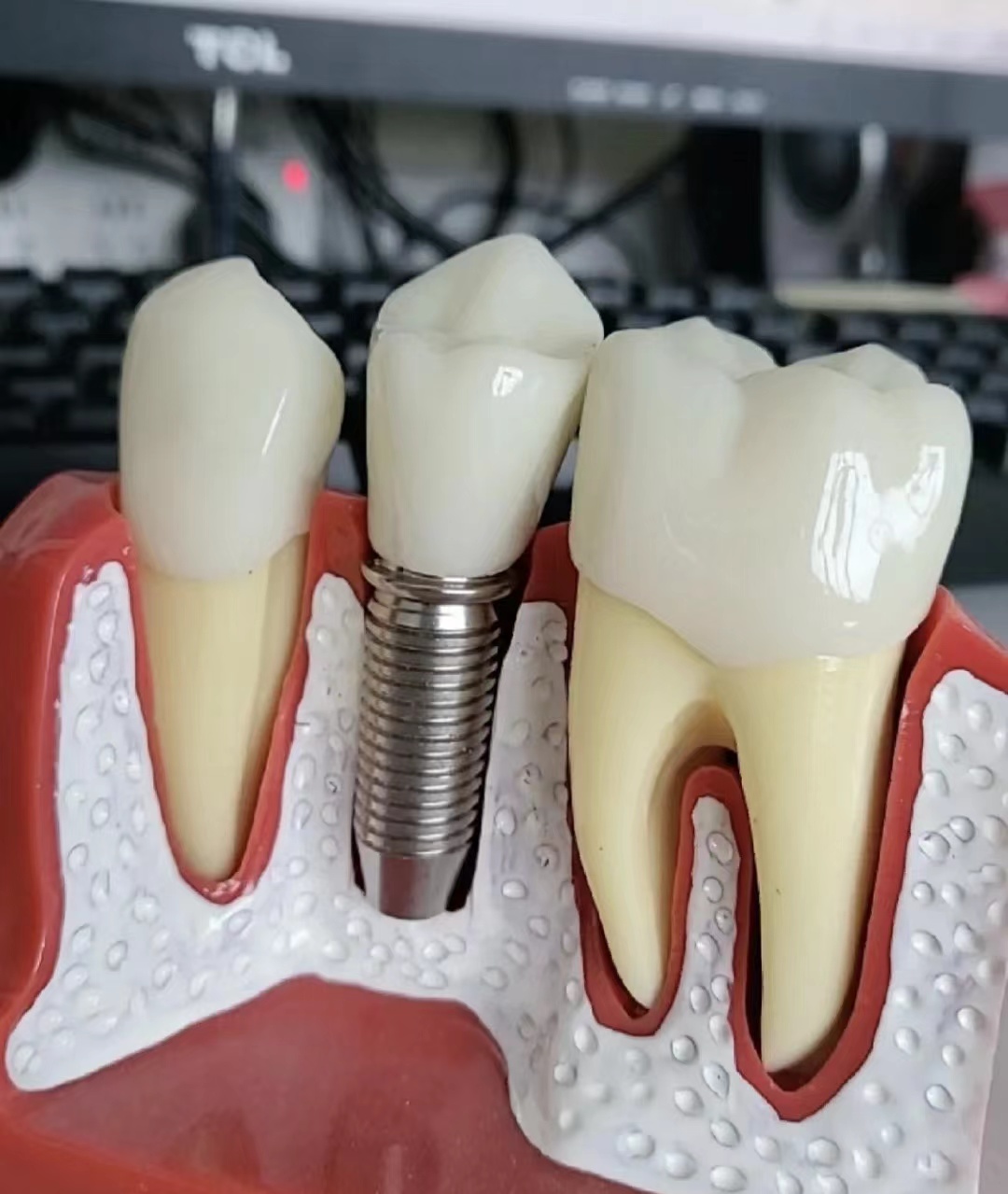 德国十大品牌种植体排行榜,权威世界十大种植体排名