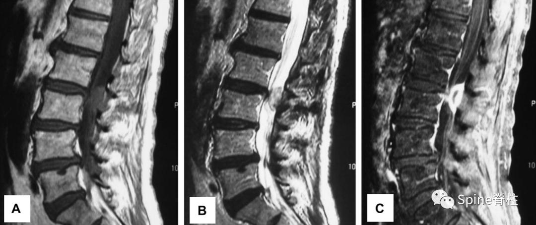 腰椎间盘突出症状表现,腰椎间盘突出症疼痛最佳止痛方法