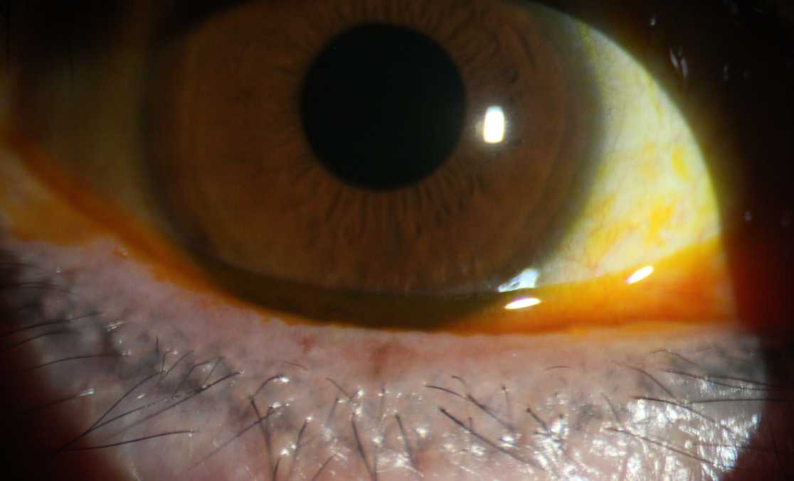 眼睛总是流泪模糊是白内障吗,眼睛总是流泪是红眼病吗