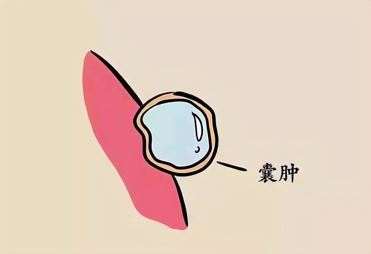 医生说有个囊肿是怎么回事,医生说囊肿是良性的但是需要手术