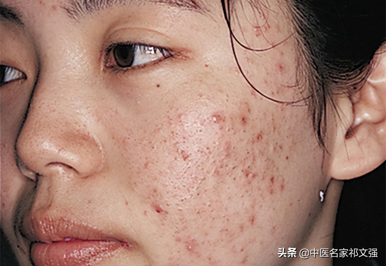 中医治脓疮偏方,火钳子疮中医治法