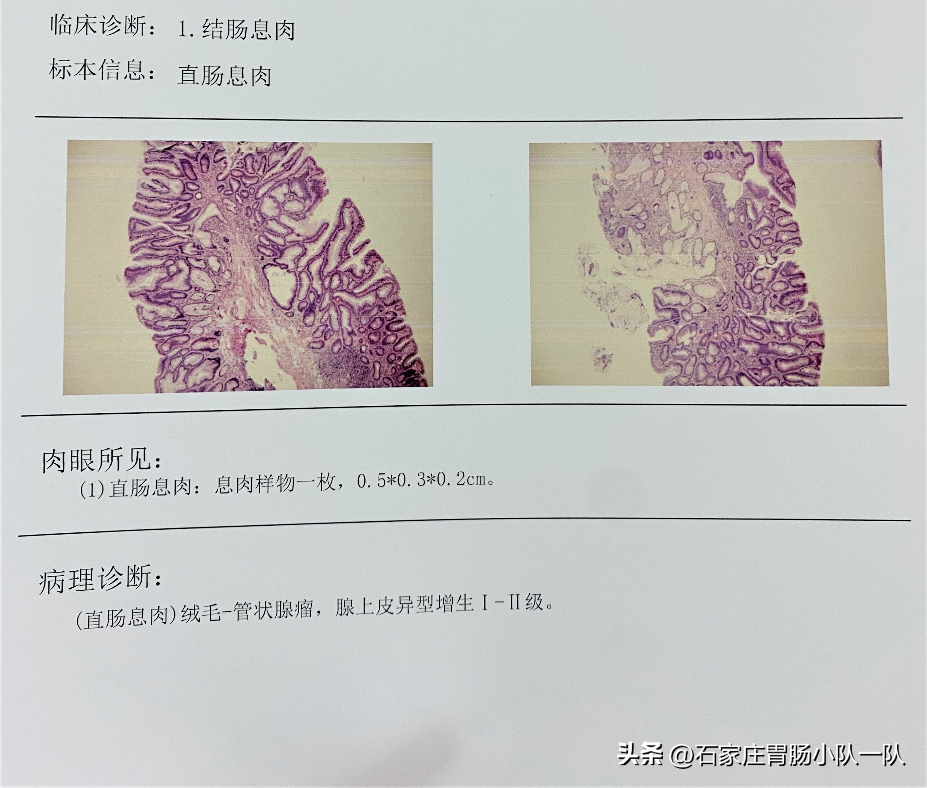 结直肠息肉的分类有哪些,结直肠息肉多大比较严重