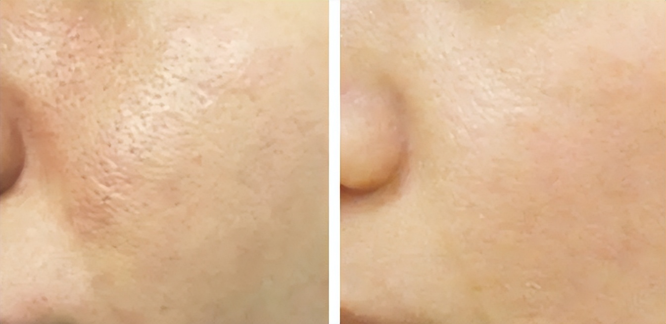 花漾缘面膜,花漾缘祛痘清洁面膜