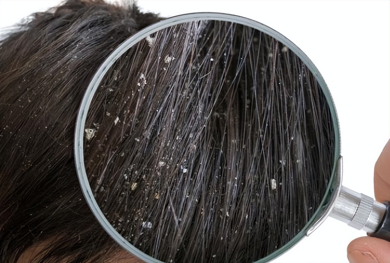 头皮上经常长疙瘩和脓包是怎么了,头皮上有脓疙瘩是怎么回事