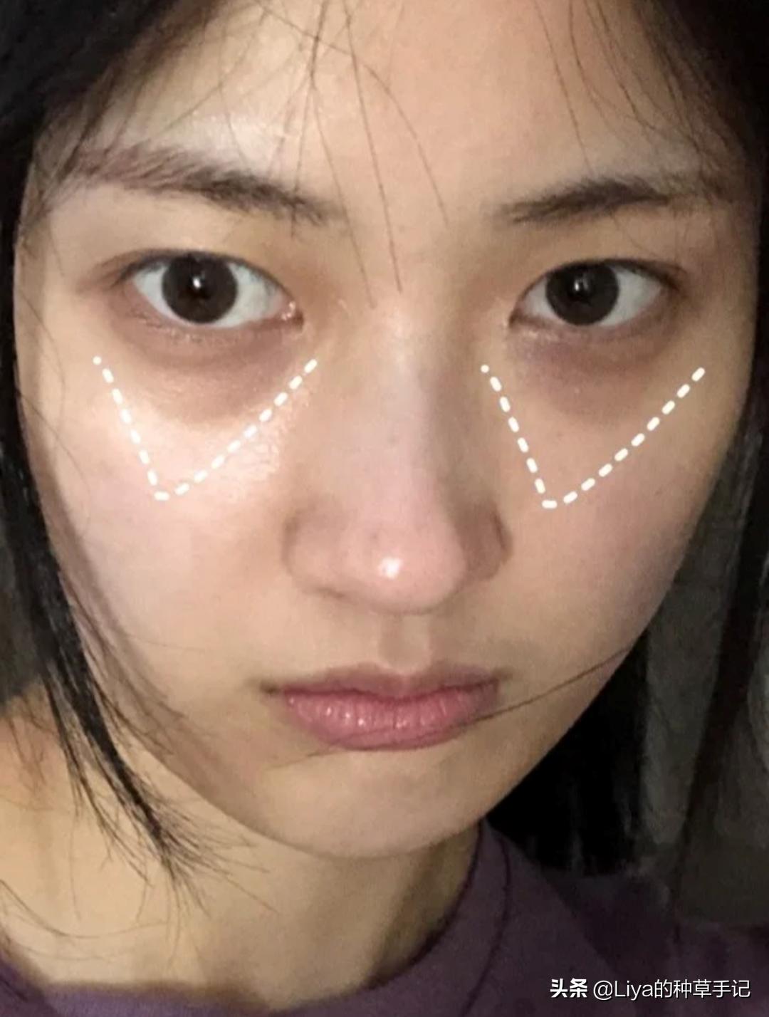 扁平脸如何拯救,扁平脸修复方法图解