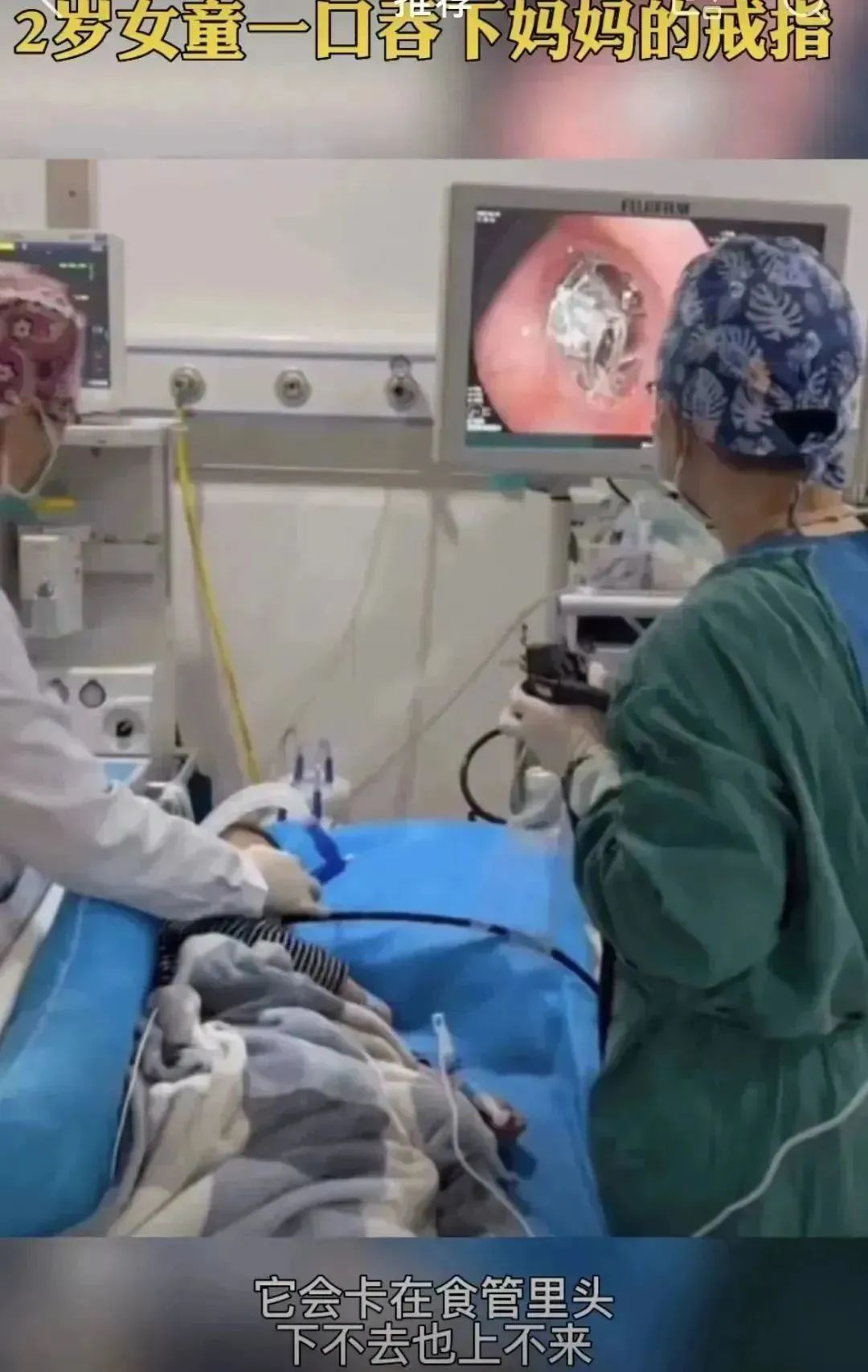 2岁女童误吞妈妈3厘米钻戒,1岁女童误吞妈妈的钻戒