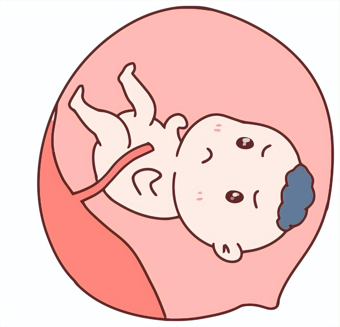 胎盘钙化影响胎儿智力吗,胎盘钙化会影响胎儿智力吗