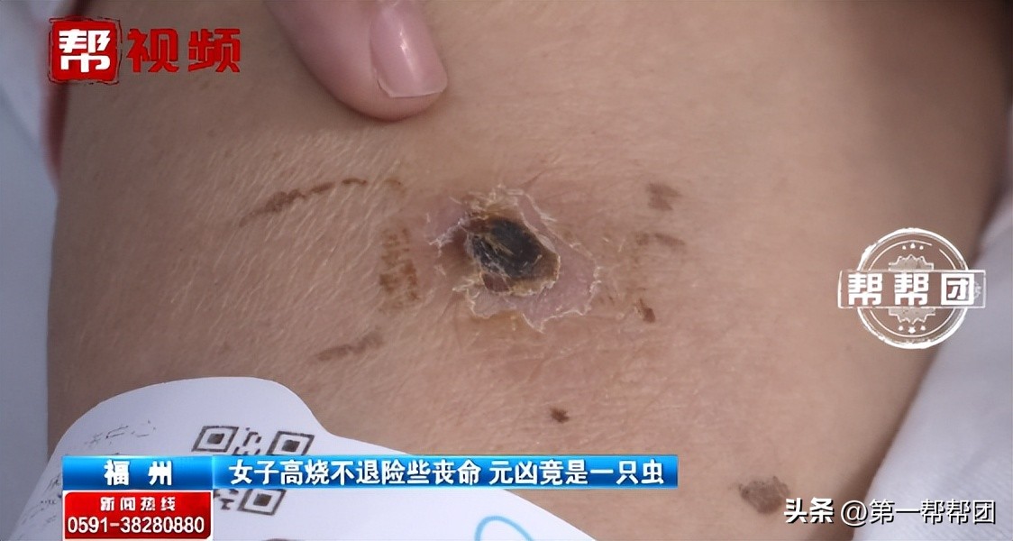 女子被恙虫叮咬持续高烧40度,福建被虫子咬到哪里医院好