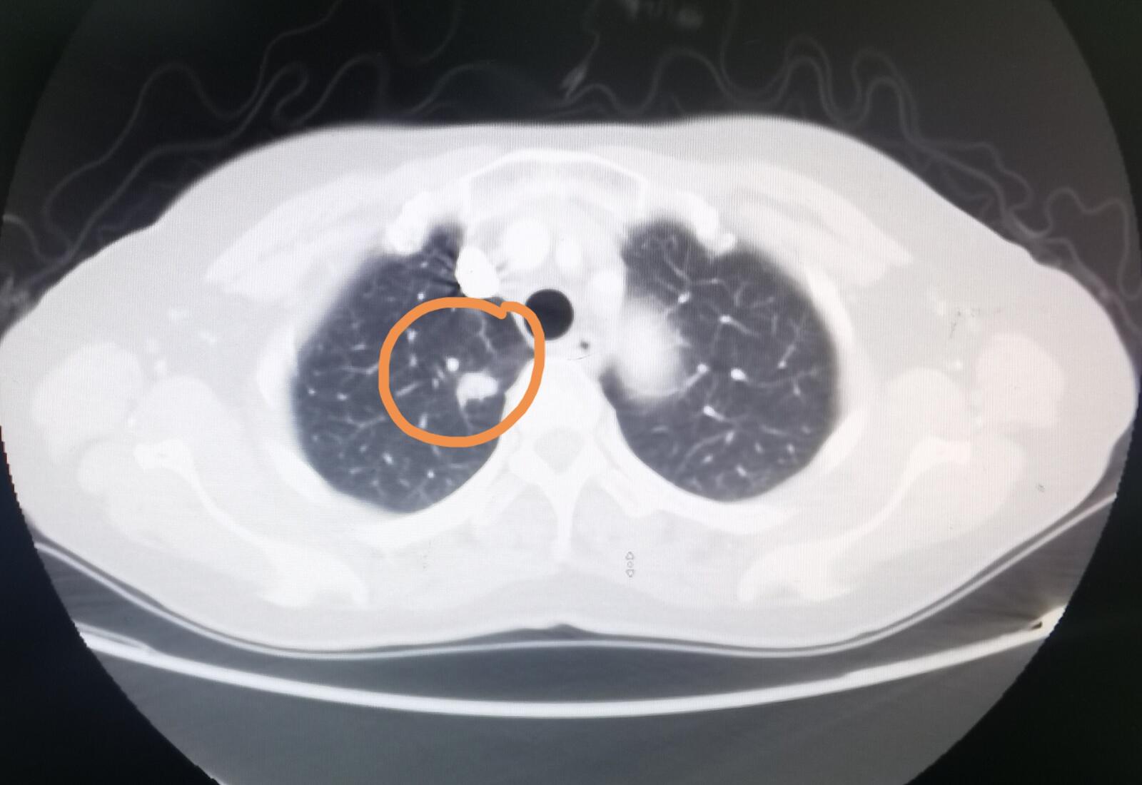 刘懿博士说肺癌毛玻璃结节,肺癌系列之五发现肺结节怎么办