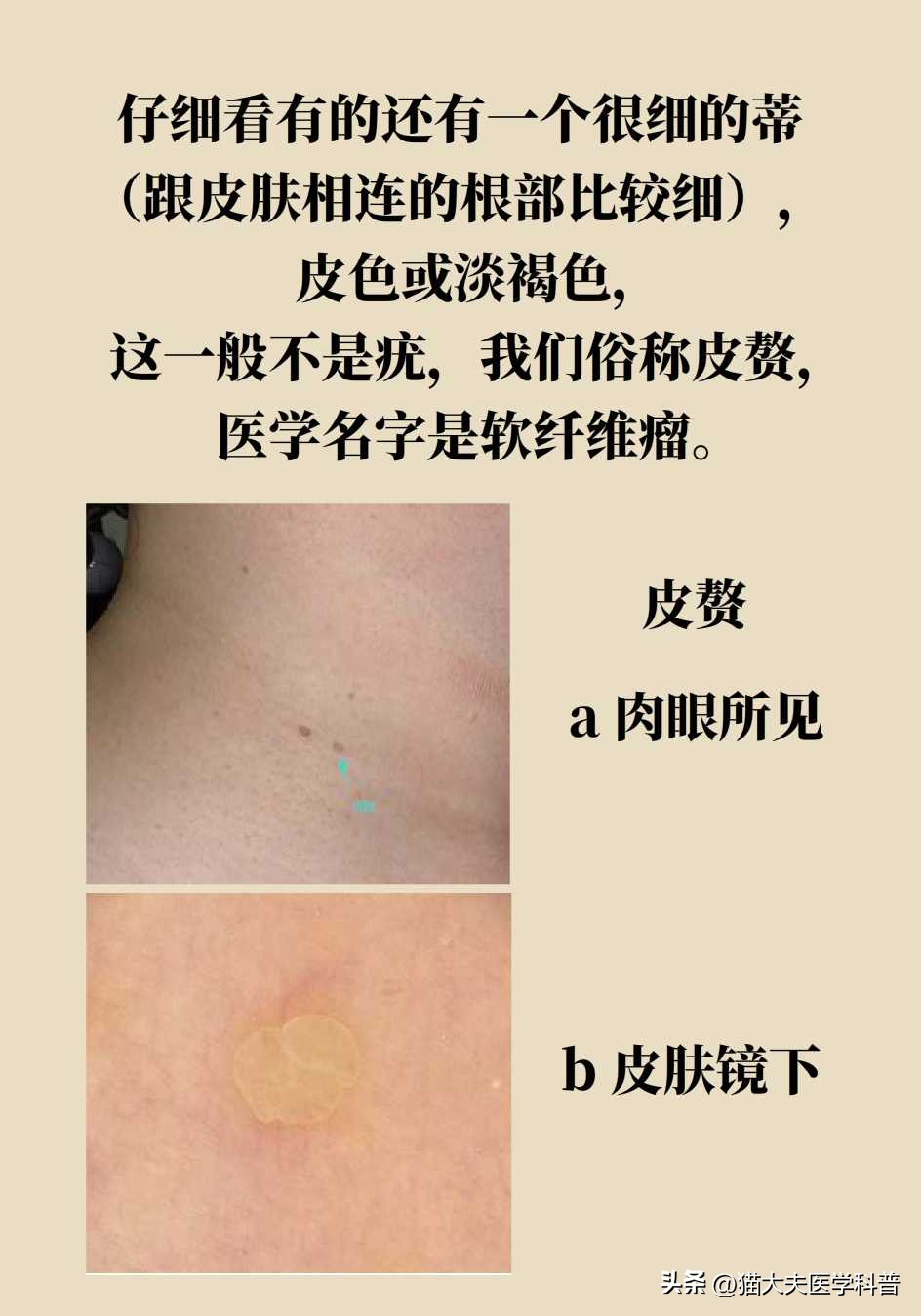 脖子上长的小肉揪怎么治啊,疣丝是不是脖子上的小肉粒