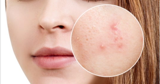 成年后长痘痘的原因怎么解决,在治痘期间还是反复长痘正常吗