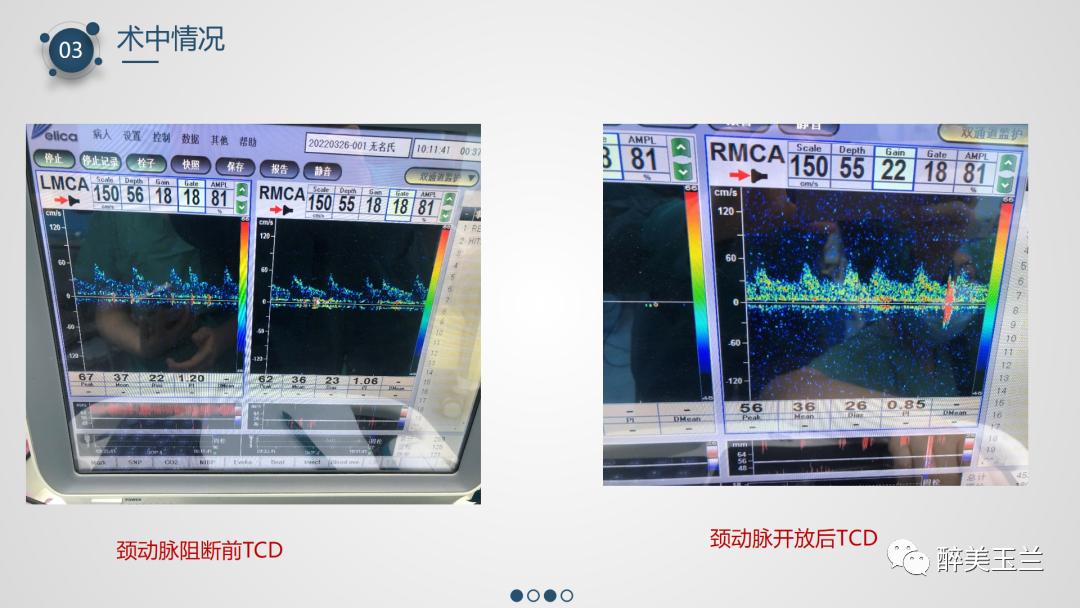 颈动脉体瘤切除术患者的麻醉管理,PPT课件