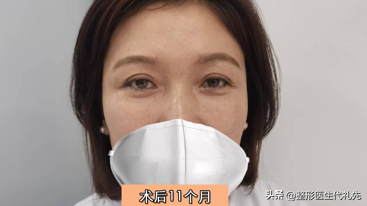 眼窝凹陷填充脂肪不成活怎么办,眼窝填充脂肪肿胀期眼睛睁不开