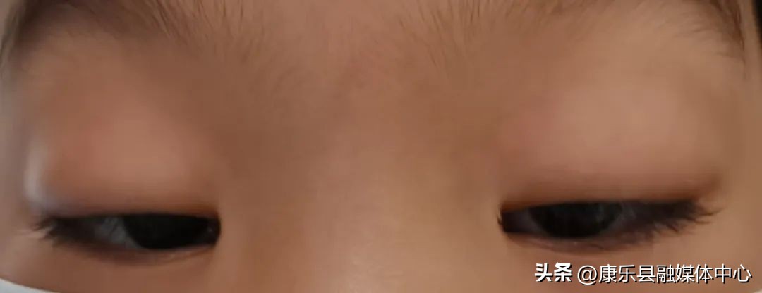 做双眼皮手术过程要睁眼睛吗,做了双眼皮后眼睛睁不大是咋回事