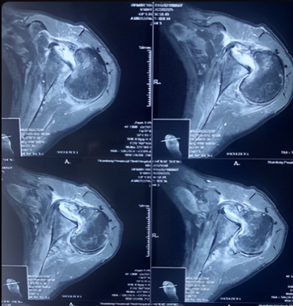 陈旧性肩关节脱臼有必要做手术吗,多年陈旧性肘关节脱臼