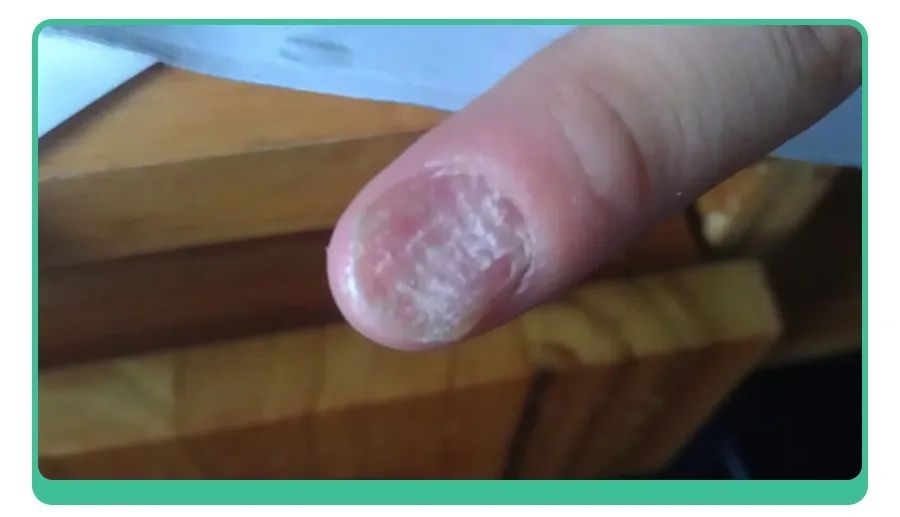 白斑、薄脆、凹陷，娃指甲有异常，不是缺营养，可能暗藏疾病