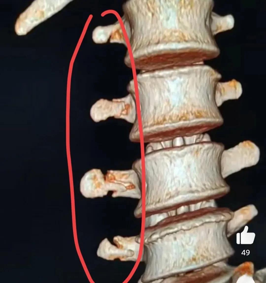 韦世豪撞断肋骨,韦世豪踢骨折