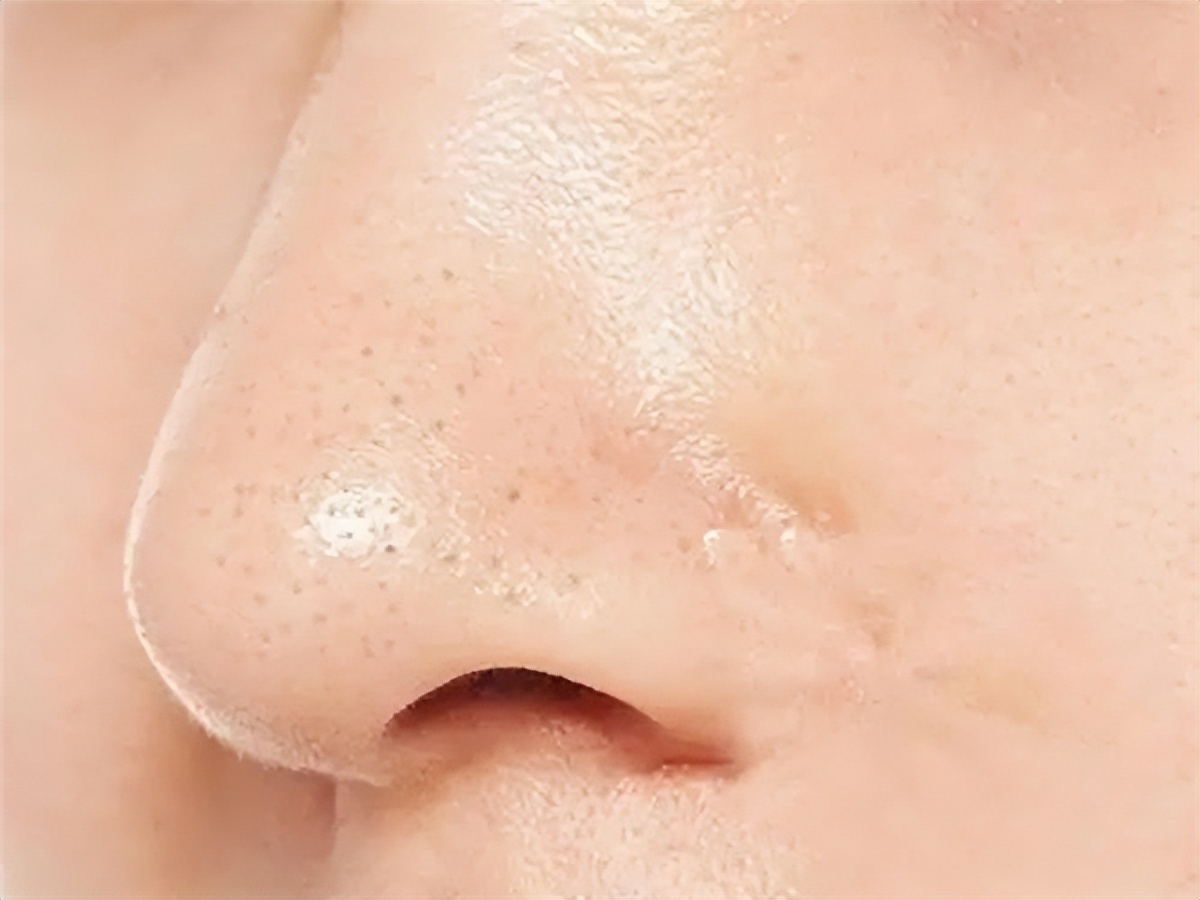 悟空祛痘青春痘能去吗,悟空祛痘毛囊净化效果怎样