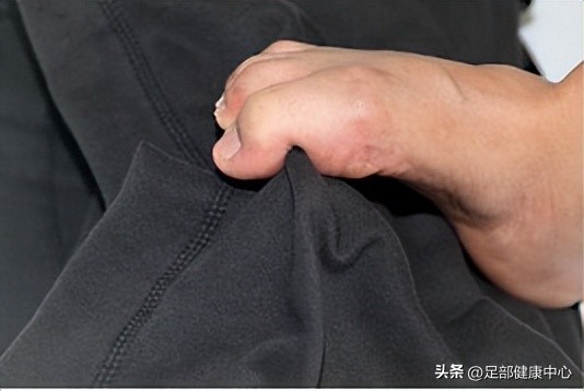 脚趾向内歪斜怎么办矫正,走路脚趾往里歪怎么矫正