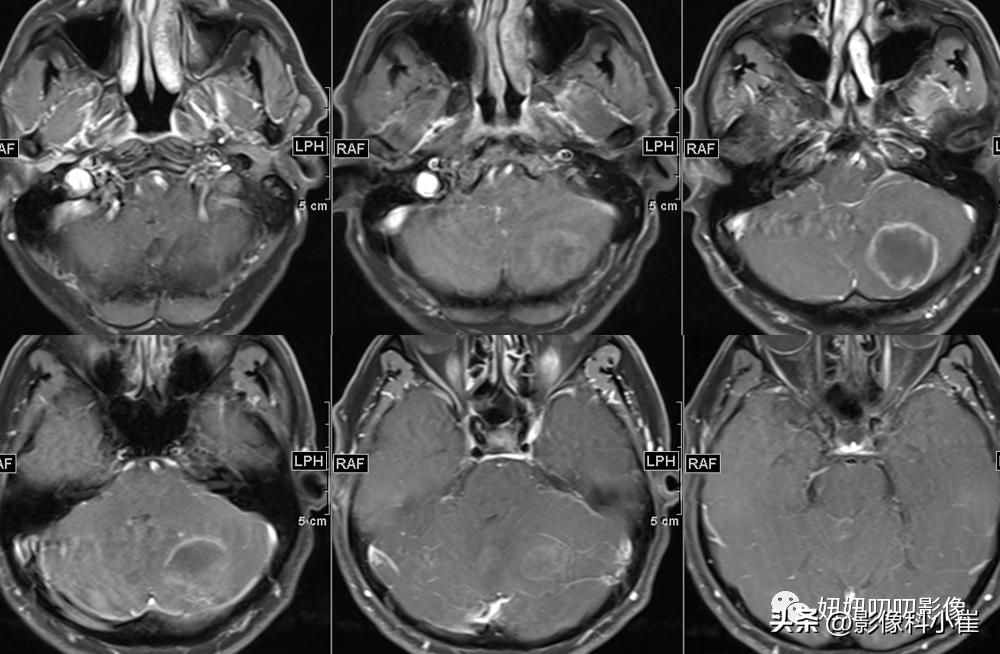 脑部局灶性强化是什么意思,脑部环形强化灶是什么意思