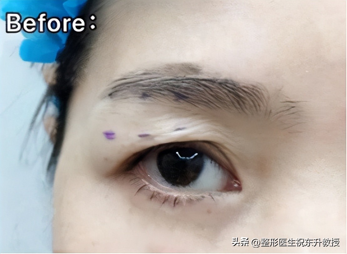 提眉手术恢复全过程,提眉手术后的真实感受