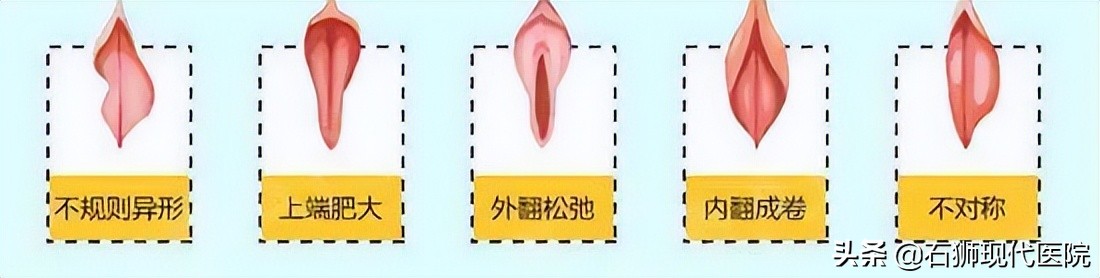 澶栭槾鍋氫簡鏁村舰鎵嬫湳浼氭湁鍚庨仐鐥囧悧,鏈夎皝鍋氳繃澶栭槾鏁村鎵嬫湳