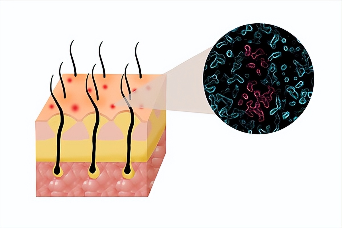共存多年的虱子不见了？不长虱子头还痒？三点做好清爽头皮防脱发