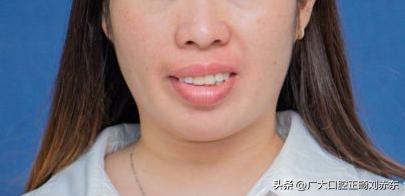 戴牙套可以改善牙齿歪吗,戴牙套可以改善脸歪嘴斜么