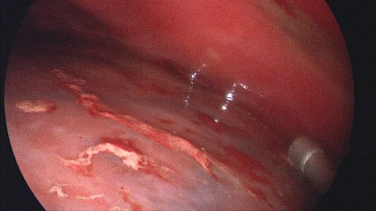 老人摔倒致硬膜下血肿哈医大一院神外梁洪生20分钟快速清除！