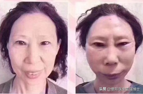 拉皮整形手术失败的案例,拉皮手术导致失败视频