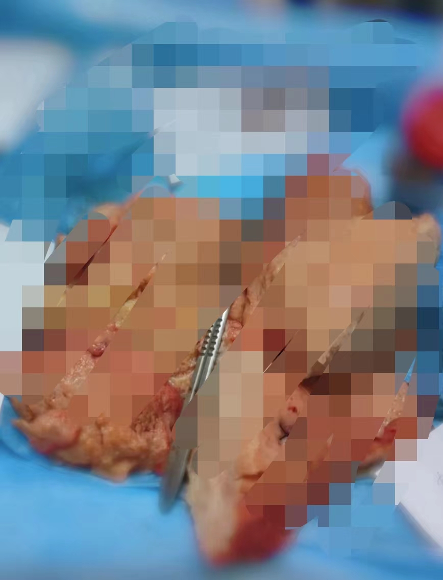 苏小姐发现自己意外怀孕了,腺肌症怀孕保胎能保住吗