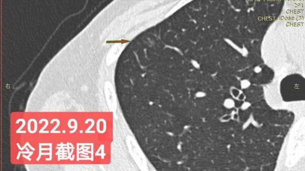 7mm肺结节恶性的怎么办,7mm实性肺结节危险程度