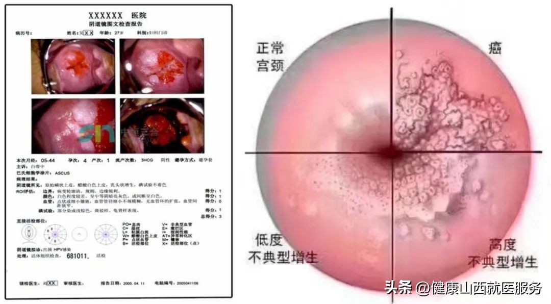*裤内**上出现这东西,可能是宫颈癌前兆!千万别拖,尽早做两个检查