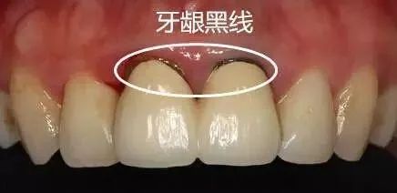 烤瓷牙什么情况要拆除,烤瓷牙崩瓷了要修复多少钱