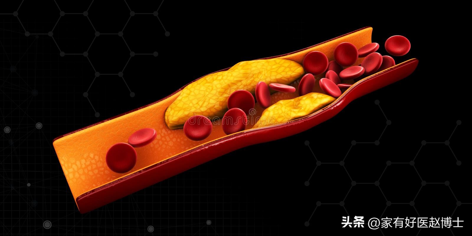有动脉斑块必须要吃阿司匹林多久,有颈动脉斑块吃阿司匹林可以吗