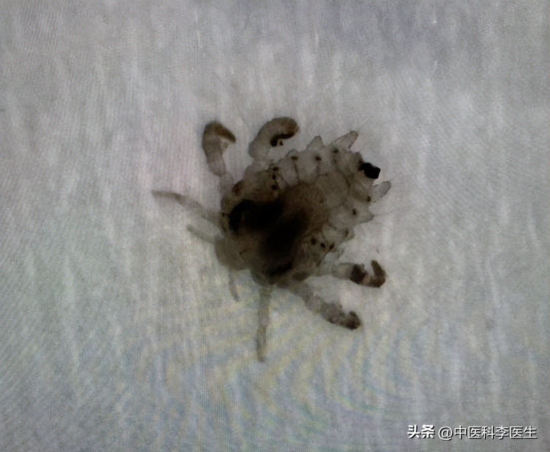 下体瘙痒发现两三只阴虱严重吗,阴部有几十只阴虱