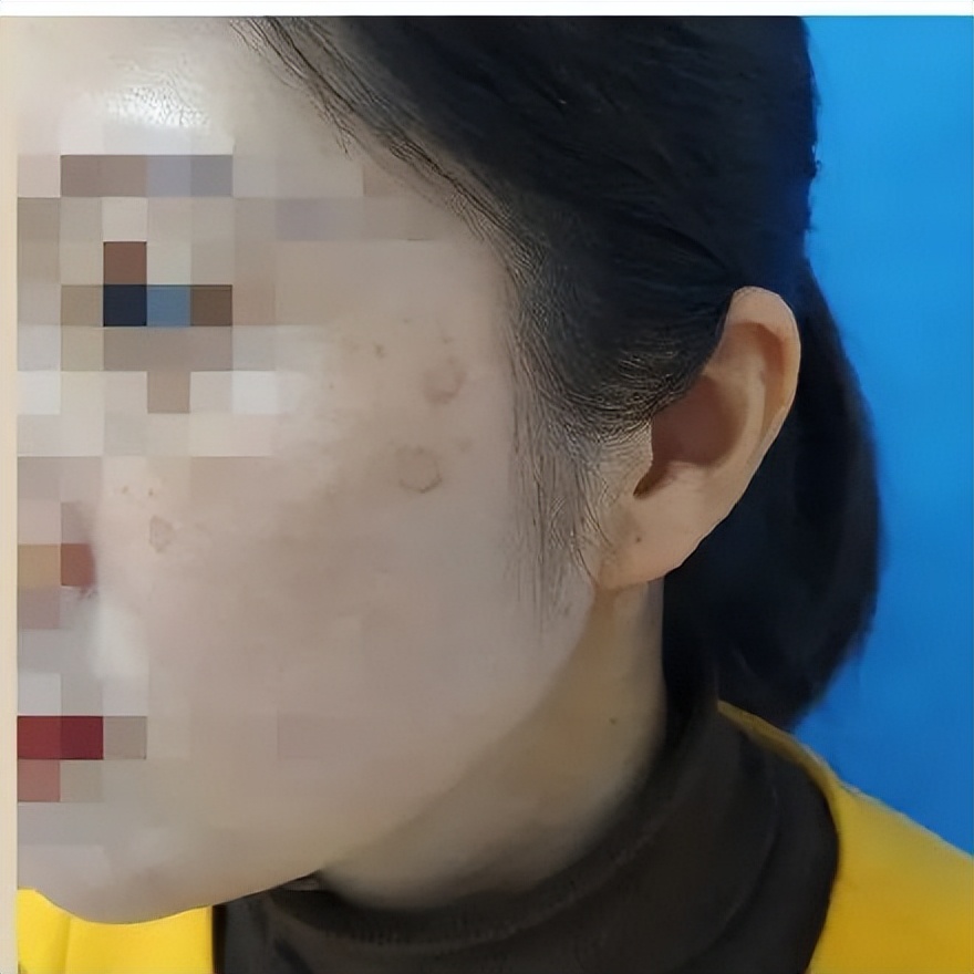 熬夜造成的老年斑长啥样,90后姑娘熬夜10年长老年斑谣言