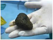 胃石就是胃石症吗,胃里像是有个石头