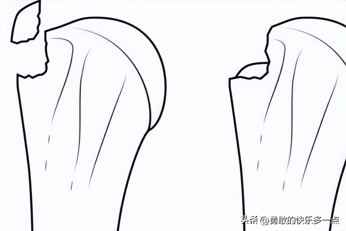 撕脱骨折后遗症,什么是撕脱骨折