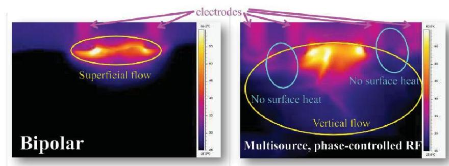 美迪迈相控微针是什么,美迪迈相控微针多久能化妆