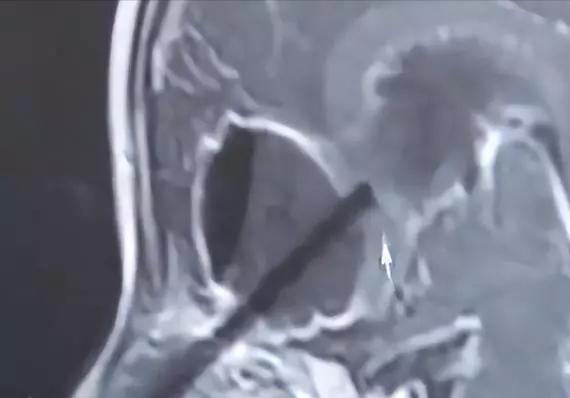 11岁男孩突然高烧呕吐,14岁孩子突发脑炎呕吐