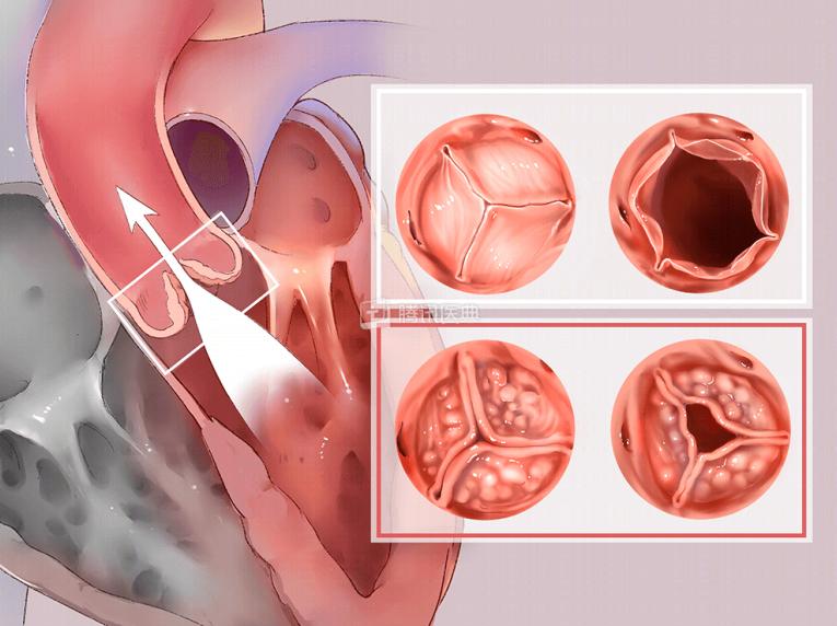 河南大学淮河医院顺利为一例二叶式主动脉瓣重度狭窄伴重度钙化的病人实施了经导管主动脉瓣置换术