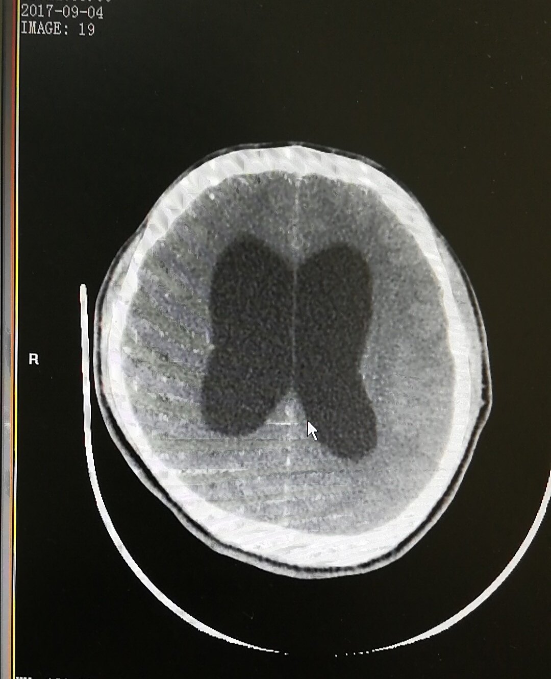 动脉瘤蛛网膜下腔出血术后并发症,动脉瘤导致蛛网膜下腔出血严重吗