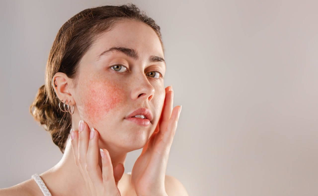 敏感肌动不动就大红脸,动不动满脸通红是怎么回事