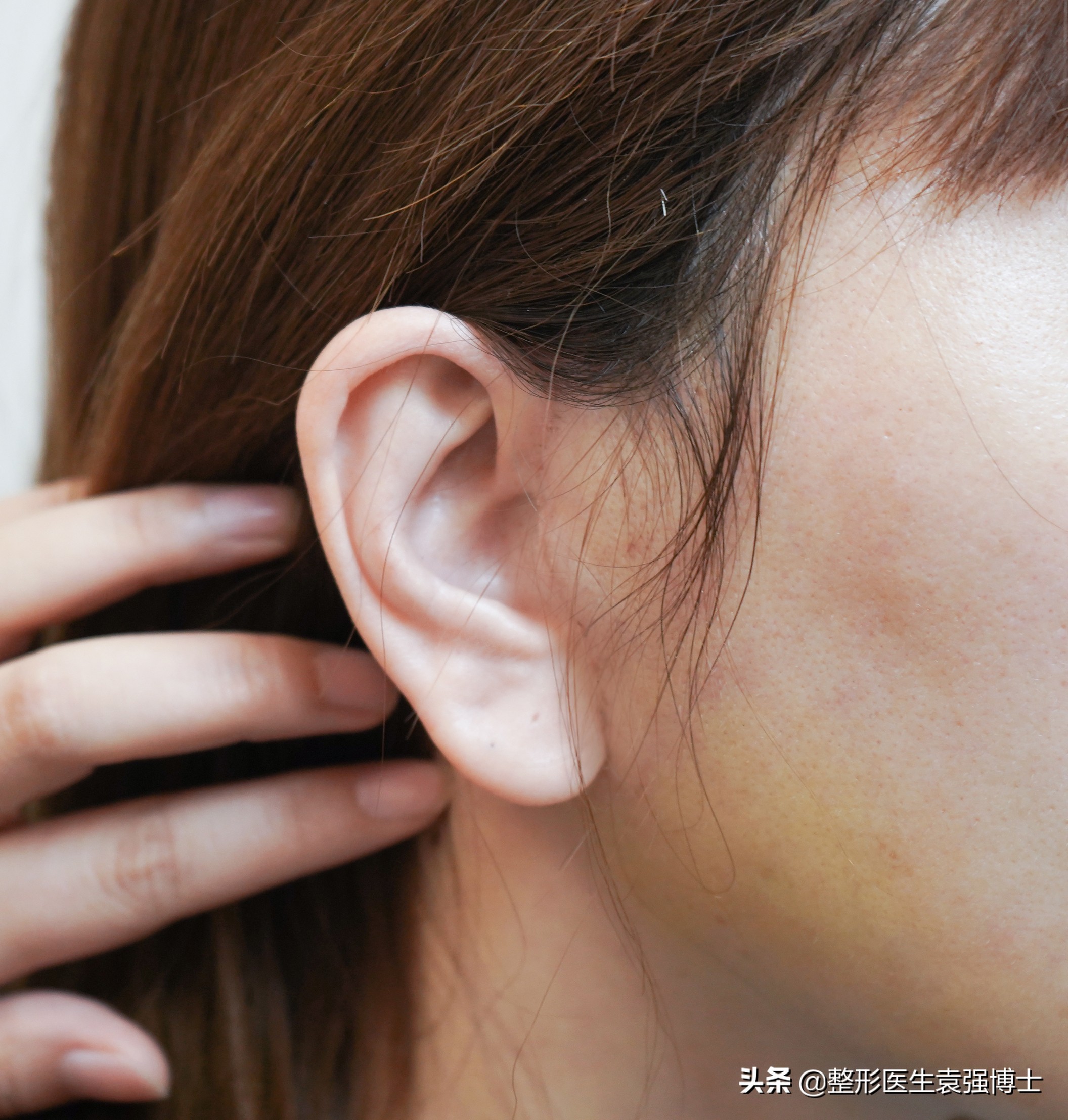 拉皮后10年后的后遗症的真实案例,拉皮手术后遗症出现在什么时期