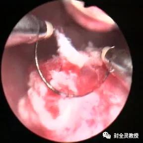 妇科专家教你认识宫腔镜,宫腔镜妇科主任