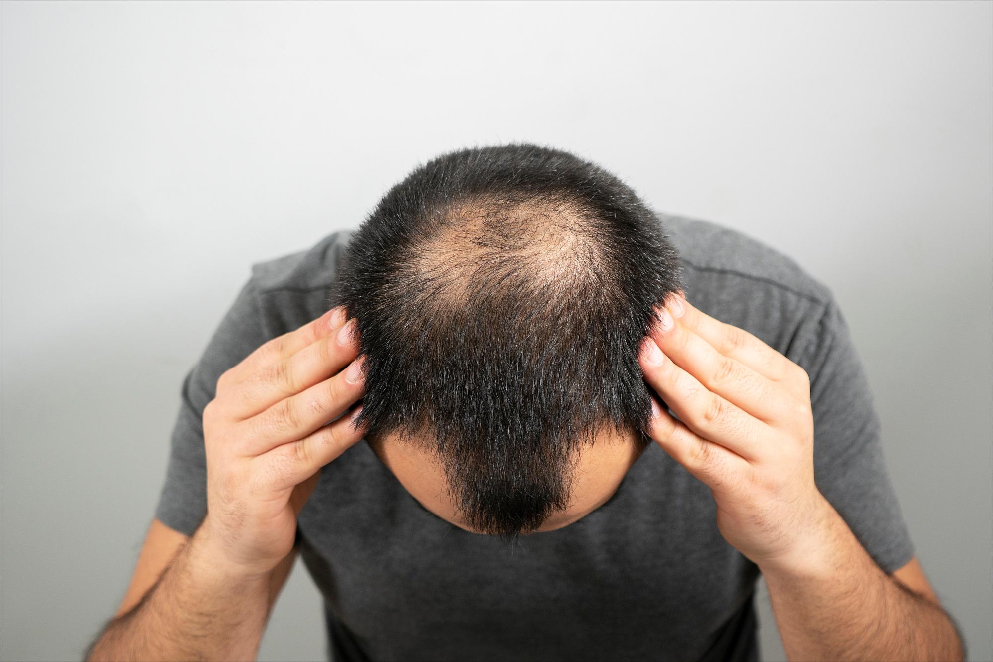 妞嶅彂鏄案涔呯殑杩樻槸鏈夌淮鎸佹椂闂寸殑,璇烽棶妞嶅彂鏈夋晥鍚楄兘缁存寔澶氫箙