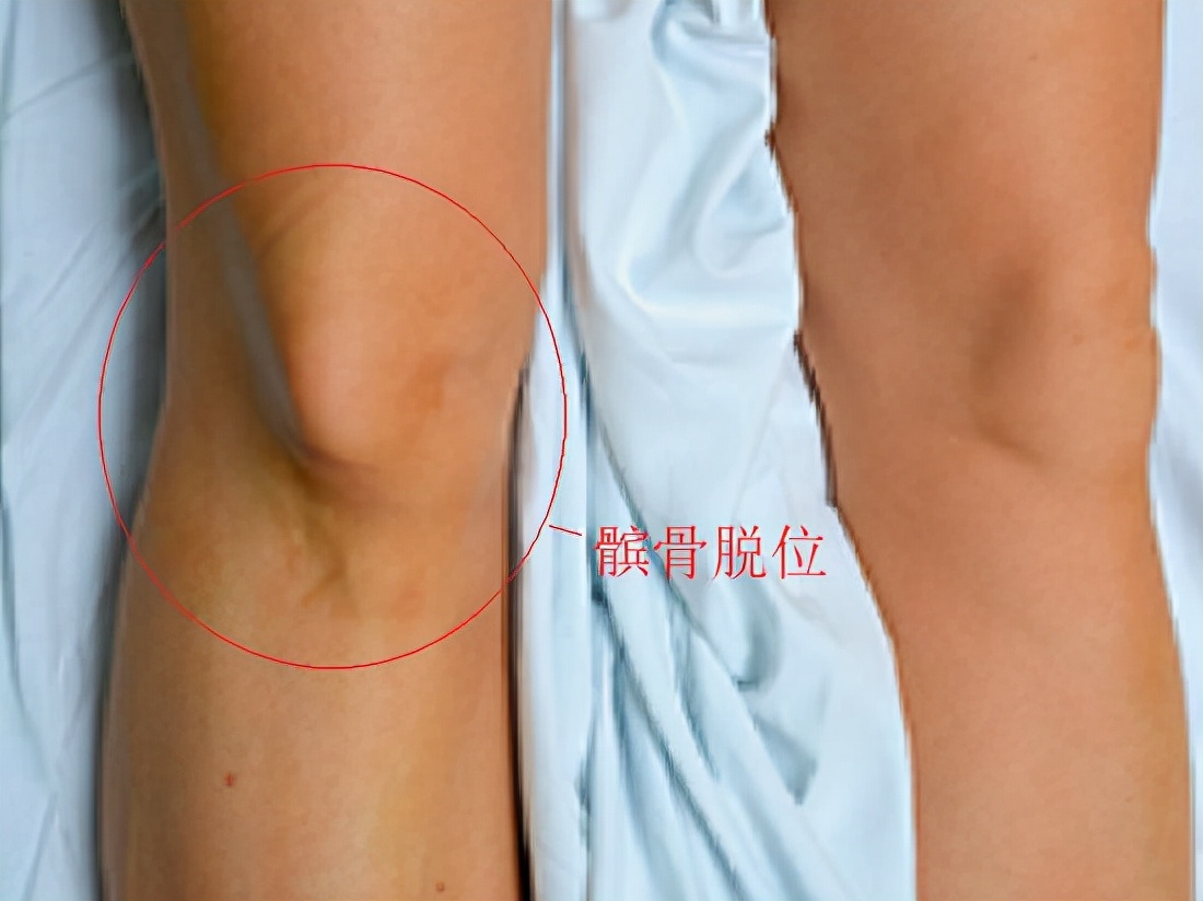 髌骨软化症治疗方法以及康复训练,髌骨软化症康复训练方法