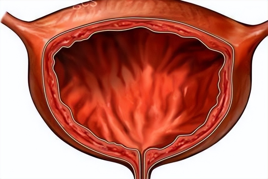 手术后插尿管是啥样的,手术插尿管是不是最后一步