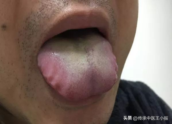 齿痕舌和裂纹舌中医辨证,舌胖大有齿痕中医辨证